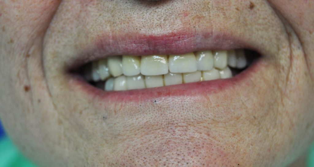 Faccette-dentali-provvisorie-e-faccette-dentali-definitive-studio-dentistico-dottor-gola-23