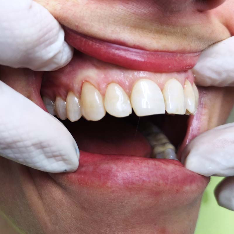 faccette-dentali-tutto-cio-che-ce-da-sapere-studio-dentistico-dottor-gola-1