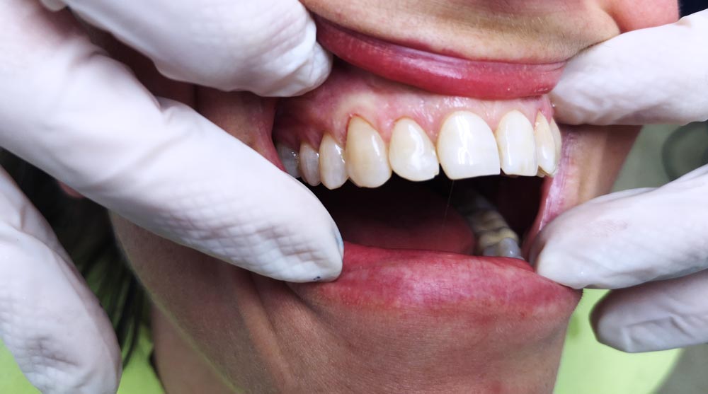 faccette-dentali-tutto-cio-che-ce-da-sapere-studio-dentistico-dottor-gola-2