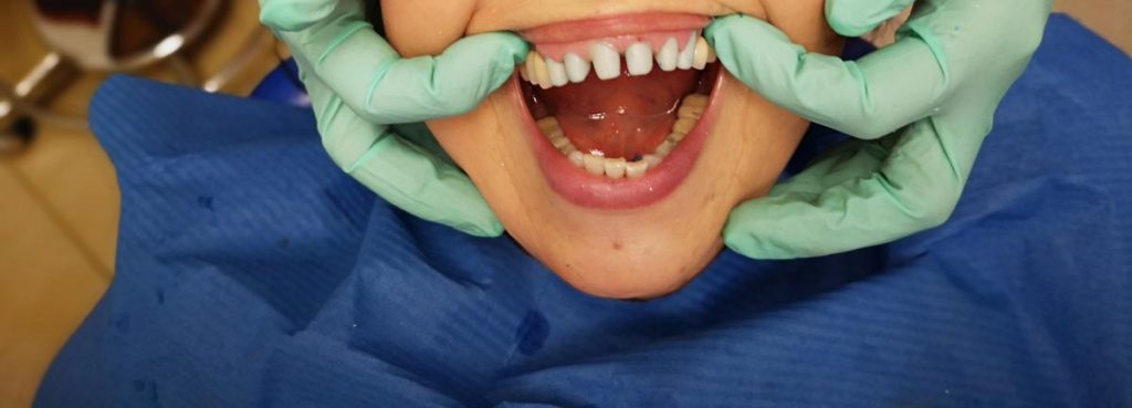 faccette-dentali-tutto-cio-che-ce-da-sapere-studio-dentistico-dottor-gola-3