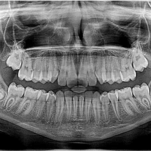 Implantologia-dentale-vantaggi-e-controindicazioni-studio-dentistico-dottor-gola-1