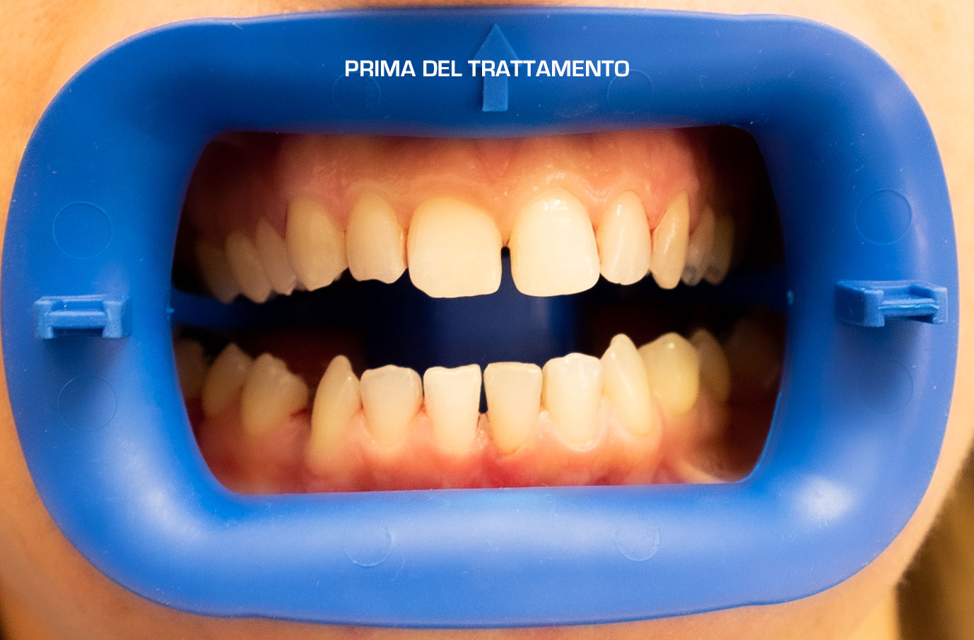 invisalign-raddrizzare-denti-storti-sbiancamento-denti