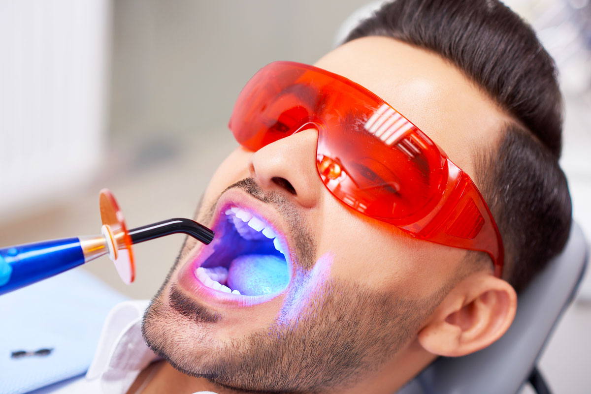 Sbiancamento-dentale-studio-dentistico-dottor-gola-dentista-casteggio-pavia-3